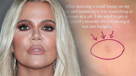 chloe skin cancer|khloe kardashian cancer scare.